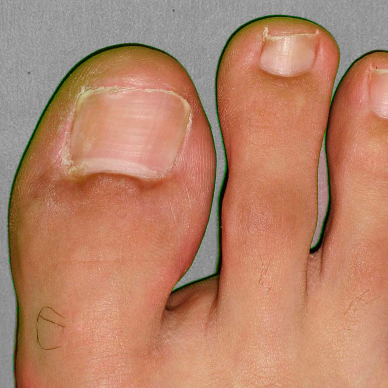 INGROWING TOENAIL SURGERY Leeds Yorkshire Foot HospitalYorkshire Foot