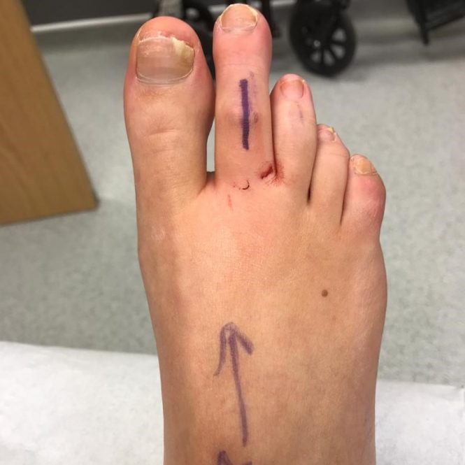 Toe Shortening Hammer Toe Surgery Leeds Yorkshire Foot Hospital