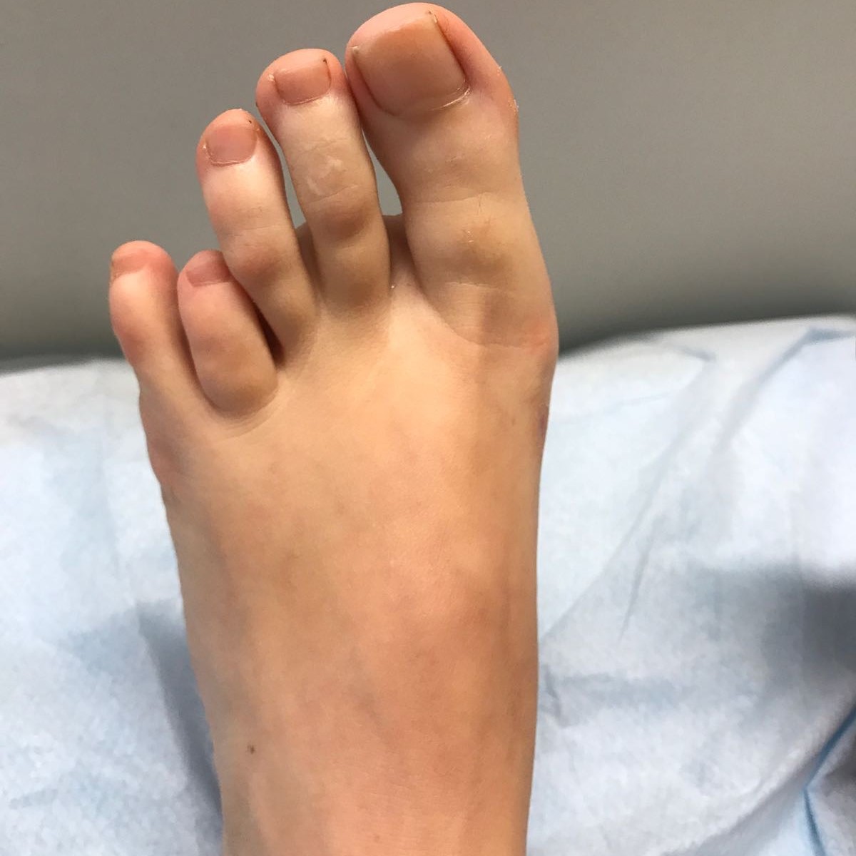 Types Of Toe Surgery at Mary Carter blog