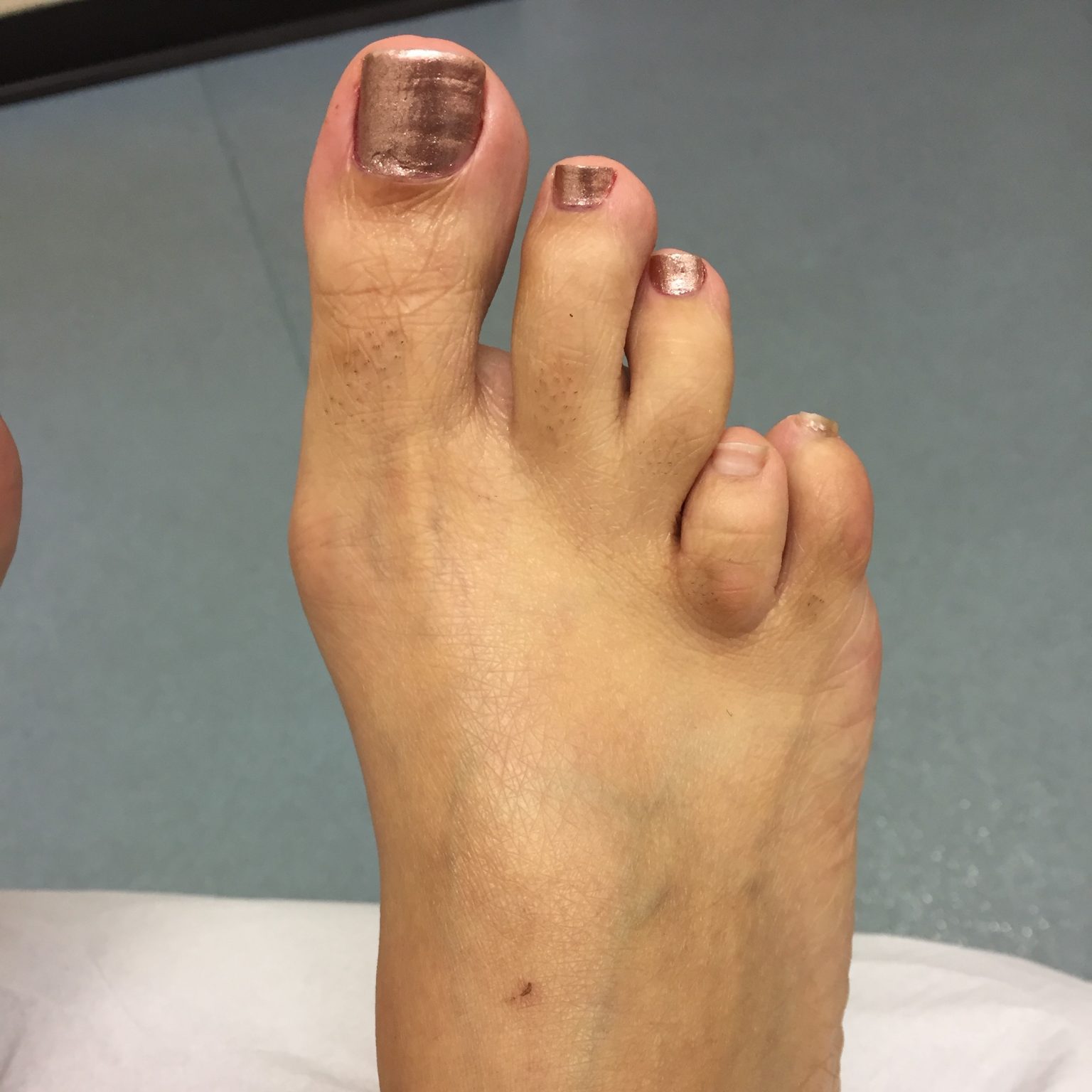 Toe lengthening Surgery in Leeds Yorkshire Foot HospitalYorkshire