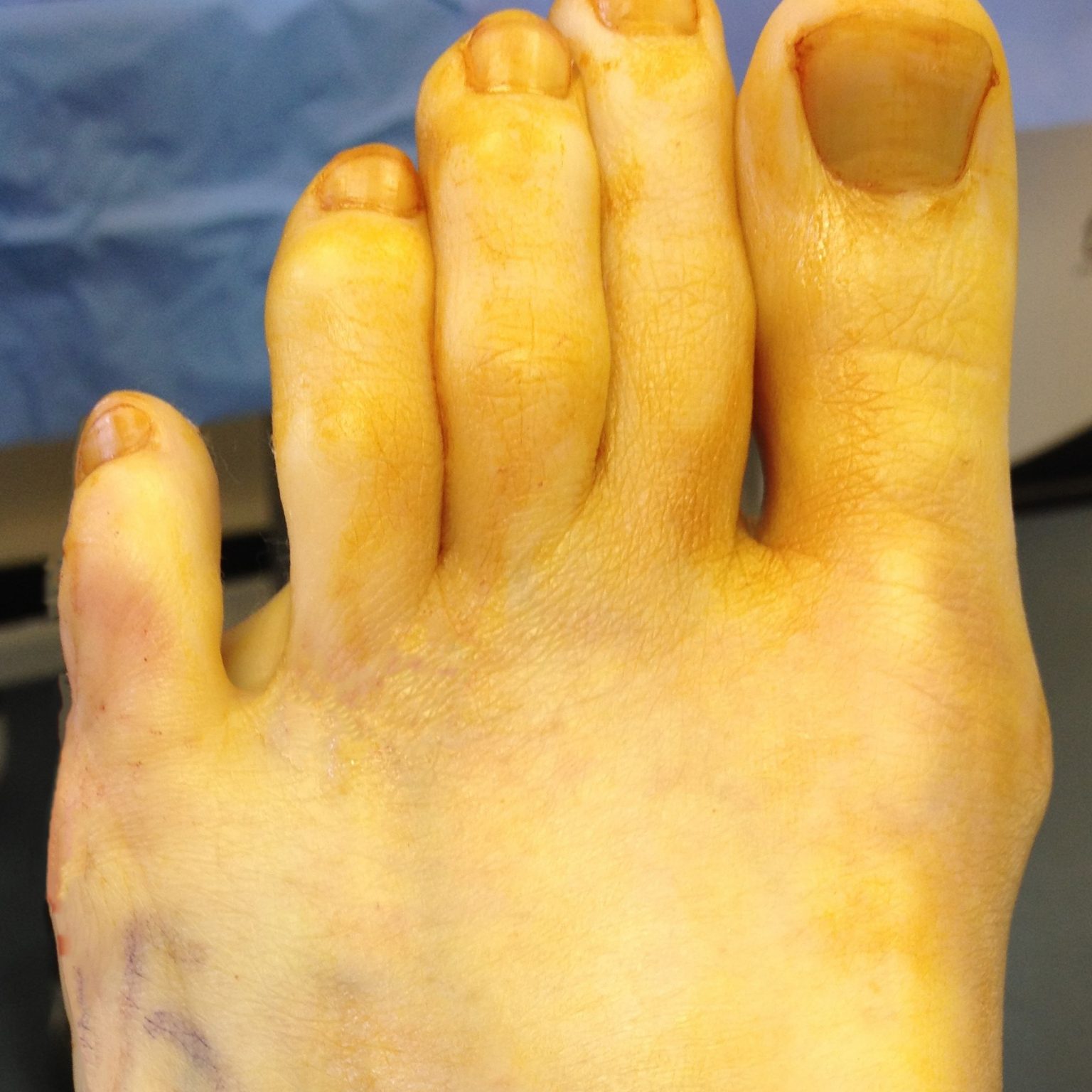 Bunion Surgery Leeds, Yorkshire Foot HospitalYorkshire Foot Hospital