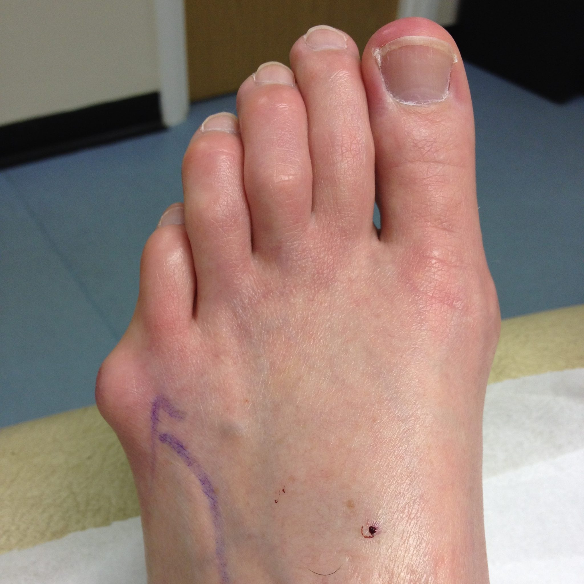 what causes bunions