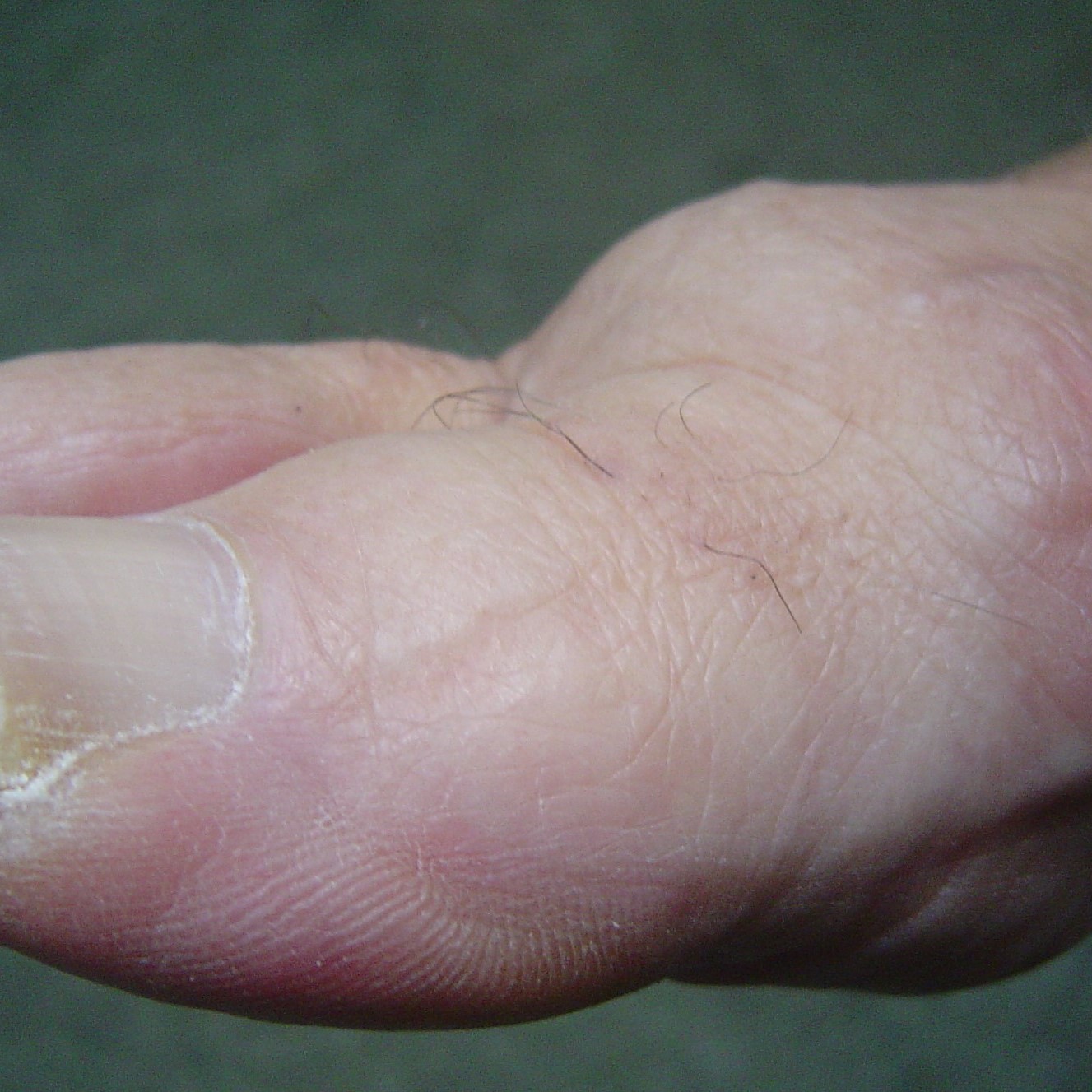 Arthritis Big toe Joint Surgery Yorkshire Foot HospitalYorkshire Foot