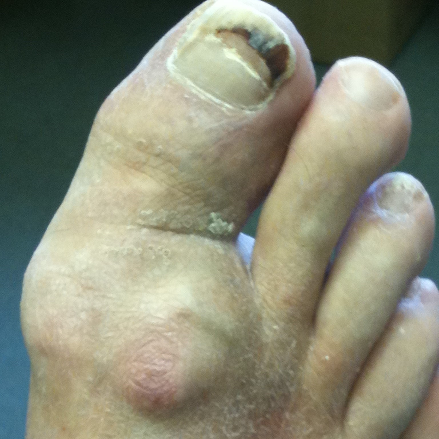 Arthritis Big toe Joint Surgery Yorkshire Foot HospitalYorkshire Foot
