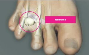 Foot surgery on neuroma